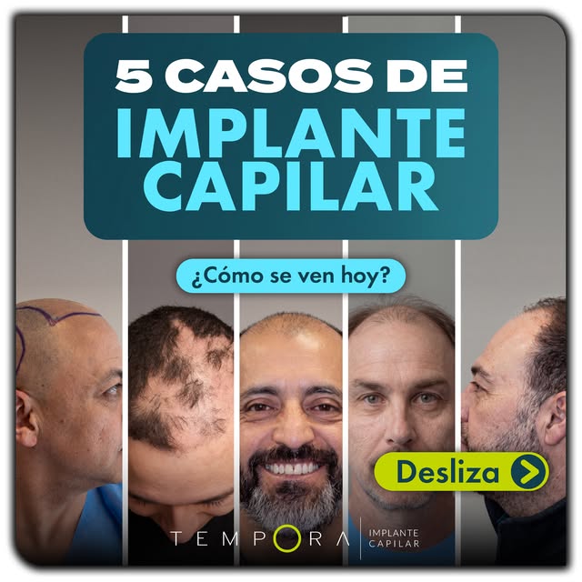 Detrás de un buen resultado de implante capilar no hay casualidad: hay estudio, planificación, una e