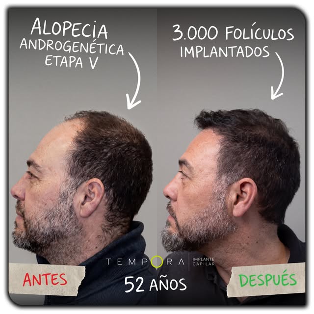 Detrás de un buen resultado de implante capilar no hay casualidad: hay estudio, planificación, una e