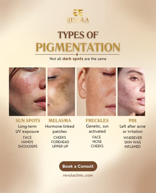 Dark spots aren't all the same; melasma, PIH, sun spots, and freckles each have a different cause.

