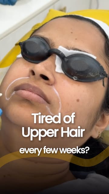 Waxing, threading, bleaching your upper lip every few weeks on repeat? 

There's a more permanent wa