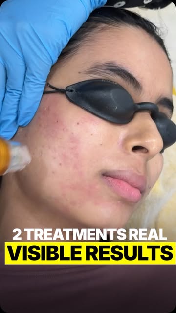 Stubborn scars, or looking for that deep, healthy glow? 
Here's what actually works: 

Microneedling