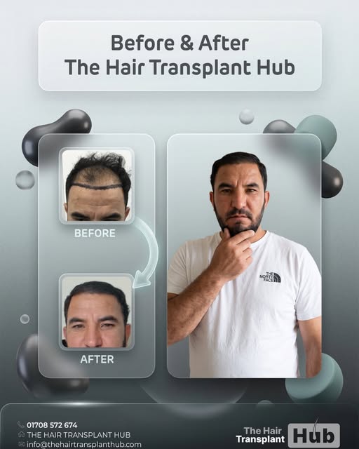 Procedure : Fue hairtransplant 5 months post

Grafts : 3000

1 day procedure 

#beforeandafter #hair