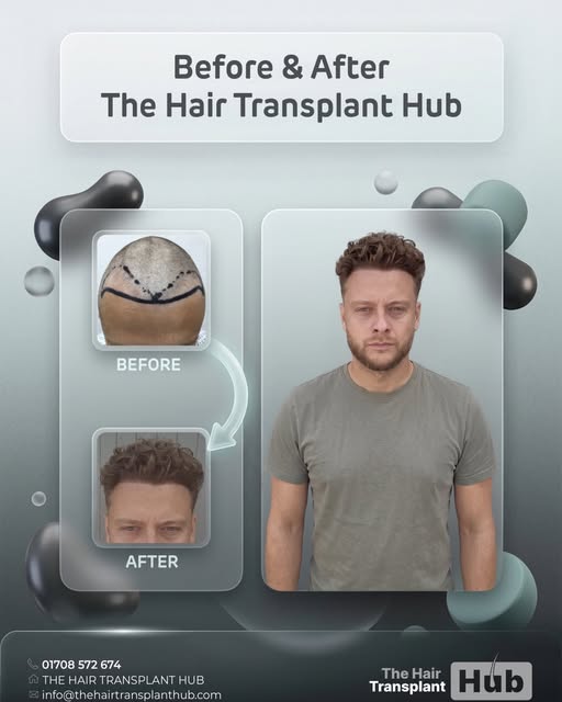 Procedure : Fue hairtransplant 12 months post

Grafts : 2000

1 day procedure 

#beforeandafter #hai
