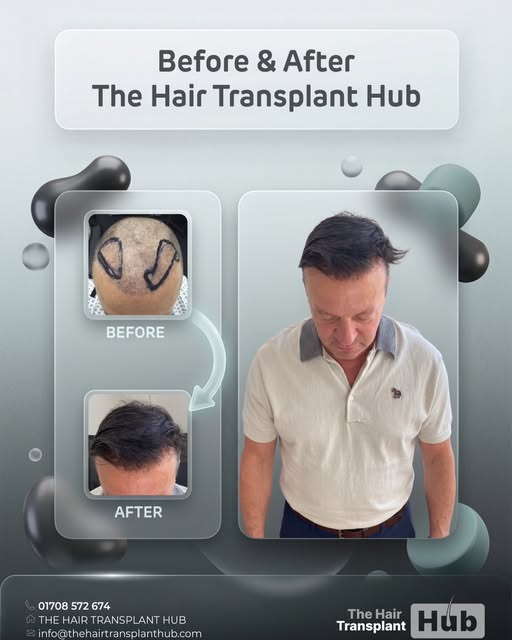 Procedure : Fue hairtransplant 12 months post

Grafts : 1600

1 day procedure 

#beforeandafter #hai