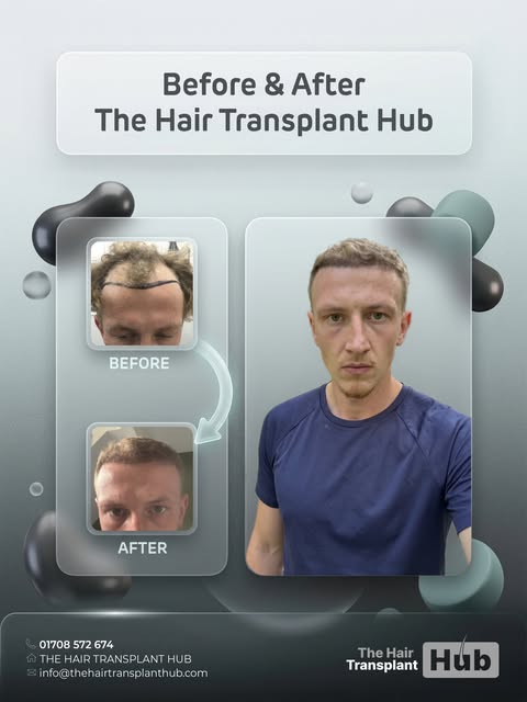 Procedure : Fue hairtransplant 6 months post

Grafts : 2700

1 day procedure 

#beforeandafter #hair