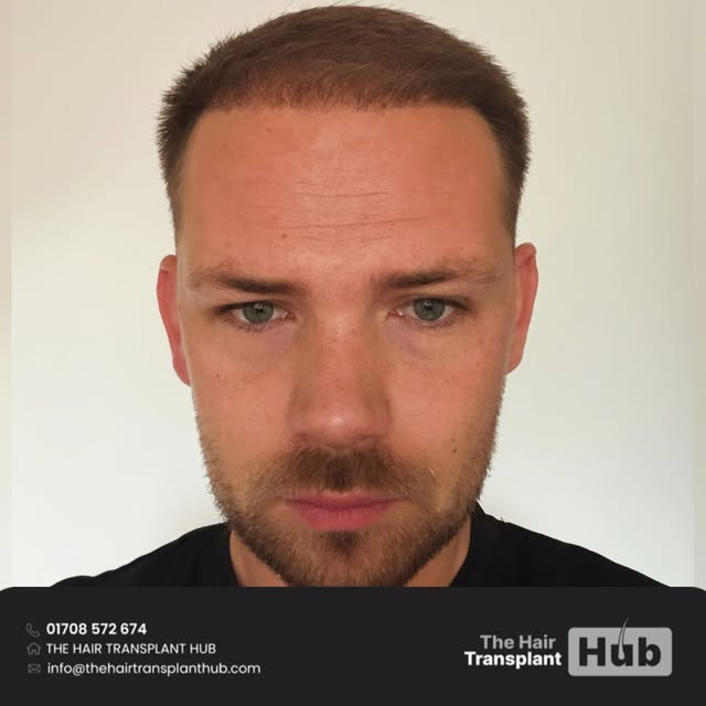 Procedure : Fue hairtransplant 6 months post

Grafts : 2800

1 day procedure 

#beforeandafter #hair