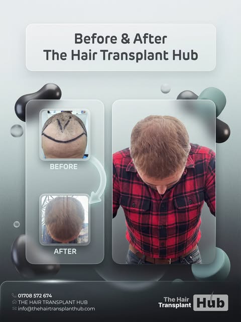 Procedure : Fue hairtransplant 18 months post

Grafts : 2680

1 day procedure 

#beforeandafter #hai