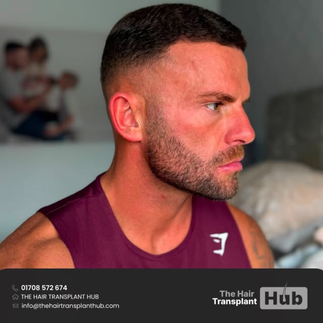 Procedure : Fue hairtransplant 9 months post

Grafts : 2400

1 day procedure 

#beforeandafter #hair