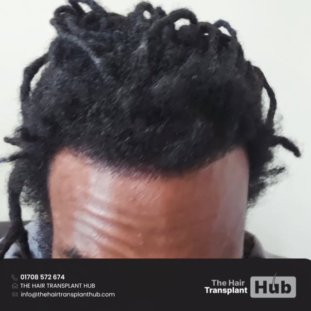 Procedure : Fue hairtransplant 14 months post

Grafts : 2040

1 day procedure 

#beforeandafter #hai
