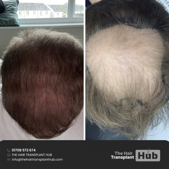 Procedure : Fue hairtransplant 12 months post

Grafts : 3050

1 day procedure 

#beforeandafter #hai