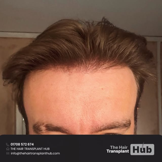 Procedure : Fue hairtransplant 9 months post

Grafts : 2600

1 day procedure 

#beforeandafter #hair