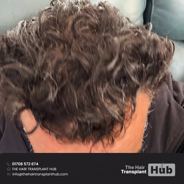 Procedure : Fue hairtransplant 12 months post

Grafts : 3000

1 day procedure 

#beforeandafter #hai