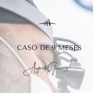 O cabelo voltou, a confiança também e o mais impressionante? Ninguém diria que houve transplante.
Qu