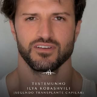 Quando começou a perceber que as entradas estavam cada vez mais marcadas, este paciente, residente n