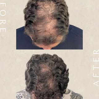 Durante algum tempo, este paciente foi-se percebendo que o cabelo na zona superior da cabeça estava 