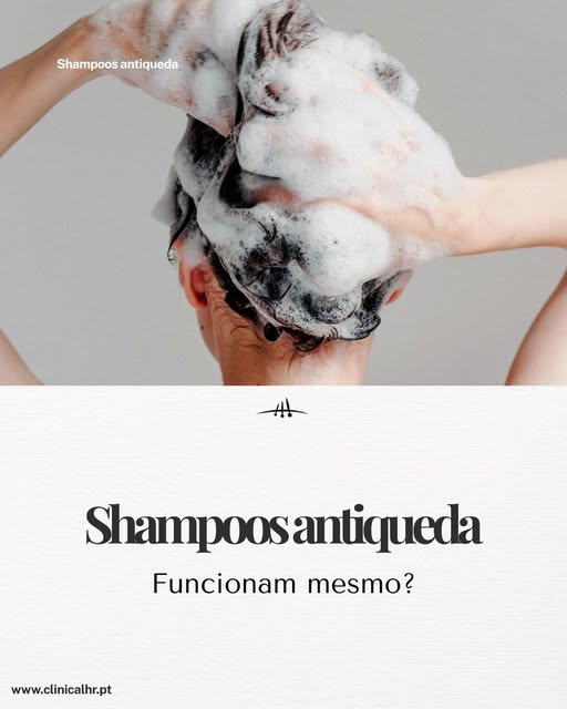 Os shampoos antiqueda podem ser um bom aliado, mas, por si só, raramente conseguem travar a queda de