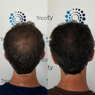 L’obiettivo è Migliorare, mettendo in conto che in futuro si possono perdere altri Capelli e NON bis