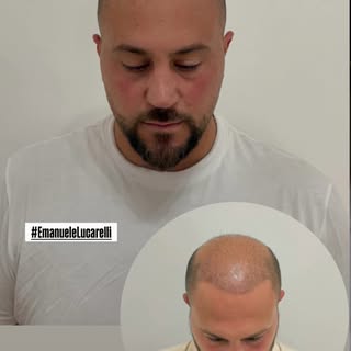 Tricopigmentazione Effetto Densità
…Post Trapianto di Capelli

#EmanueleLucarelli
#Tricopigmentazion