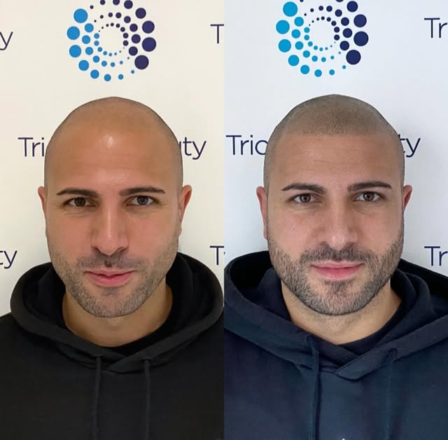 Tricopigmentazione Effetto Rasato
#Tricopigmentazione
#tricohairbeauty