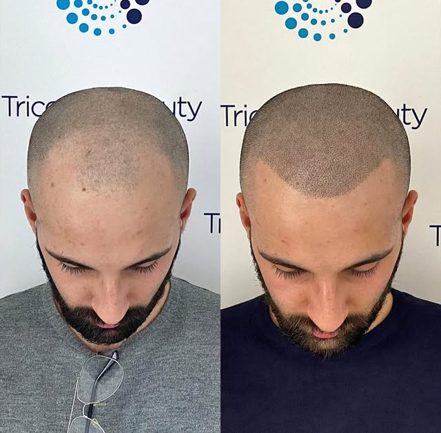 …è solo un trattamento estetico 🤔🤔🤔

#tricopigmentazione 
#emanuelelucarelli
#tricohairbeauty