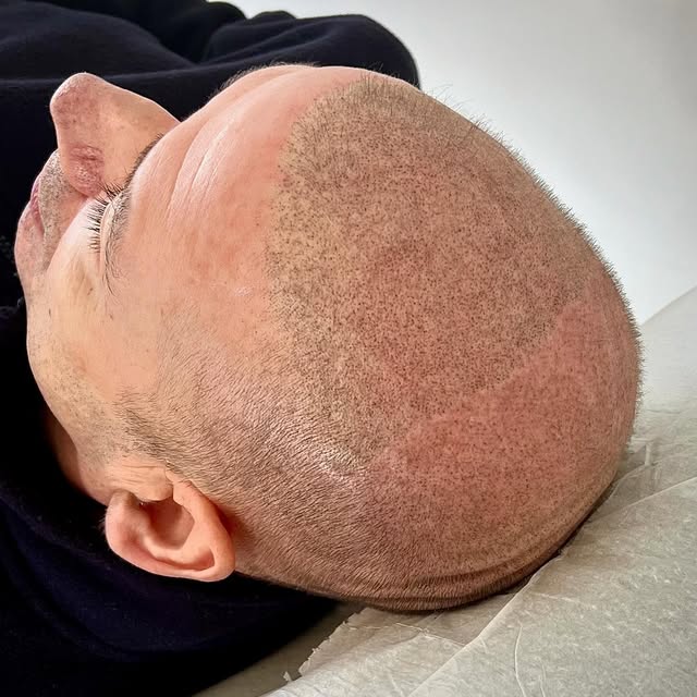 Part way through completion of the #smp procedure …. Scalp pigmentation is one of the last invasive 