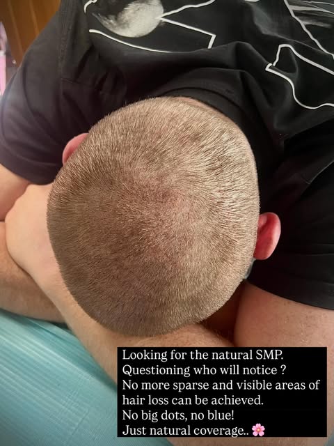 SMP is always individual . Client history is vital. Skin integrity imperative to a great result. It’