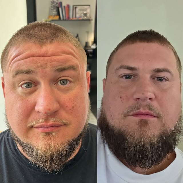 What a difference a few units of Tox can make on the 〰️➿〰️ 😮 @inclusiveaesthetics.biz #toxin #daxxi