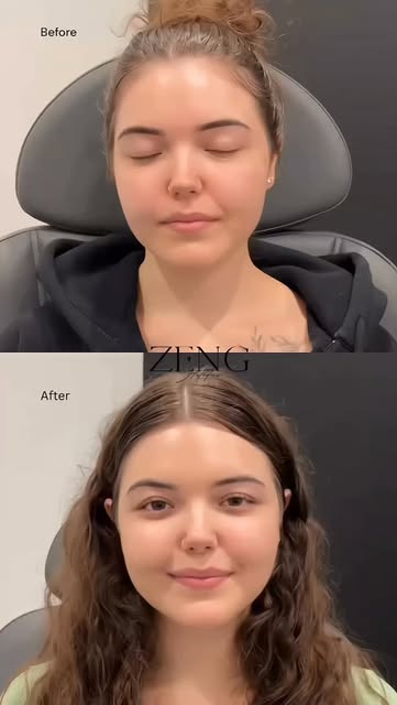 Gummy smile? I can treat that! 😁 my patient here wanted to reduce the visibility of her gummy smile