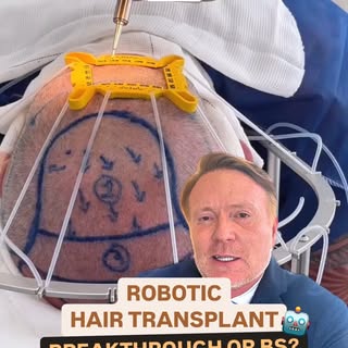 Hair transplant with a robot? Sounds modern…
But it lacks sensitivity, precision, and the human touc