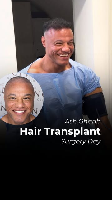 “I feel 100% better about myself and my confidence.”

For Ash having a hair transplant wasn’t just a
