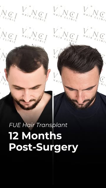 From a Norwood 2 hairline with temporal recession to a completely seamless, natural result.

When Jo