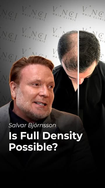 Can a hair transplant restore full hair density, or are expectations often unrealistic?

Vinci Hair 