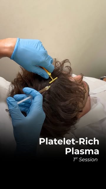 What actually happens during a PRP treatment?

PRP (Platelet-Rich Plasma) is a non-surgical treatmen