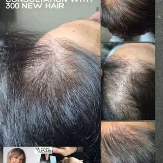 ✨ Is your hair getting thinner, but you’re not ready for a transplant or a wig?

Discover a safe, no