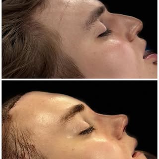 Looking back at our great result from less than a week ago. Procedures performed were: forehead cont