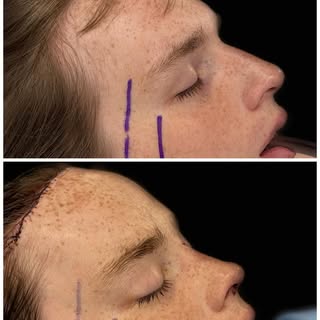 This is our before and after from the OR yesterday. The patient specifically desired a feminine fore