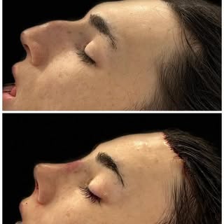 Looking back at the beautiful result from last week’s FFS. The rhinoplasty was challenging because t