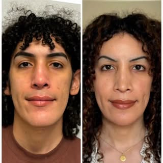 Before and 8 months after full FFS. Procedures performed were: Forehead contouring with hairline rou