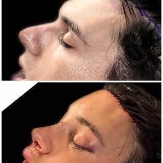 Here is a beautiful before and after from our OR of last week. Procedures performed were forehead co