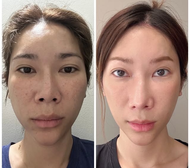 Before and 2 months after cheekbone reduction and forehead contouring procedure. These two procedure
