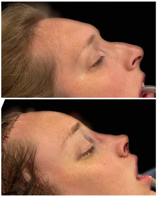 A great transformation from our FFS yesterday. Procedures performed were: forehead contouring with h