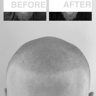 Walking into Thanksgiving dinner like he’s the main dish…

Experience the power of scalp micropigmen