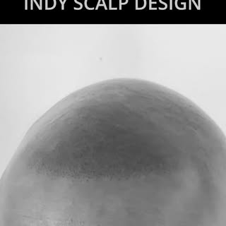 Massive transformation for our client here! Scalp Micropigmentation magic doing its thing. Reach out