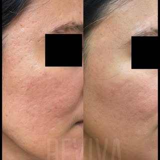 TEXTURED SKIN 

Note the textural improvement before and after one session 

Be it acne scars or ope