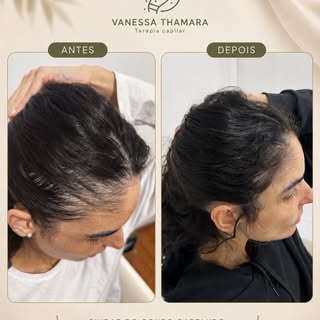 ✨ Evolução em apenas dois meses de tratamento!

Neste antes e depois, observamos uma melhora signifi