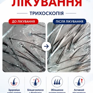 🔬 Результат лікування — проходять під контролем трихоскопії
На фото — зміни до та після лікування.
