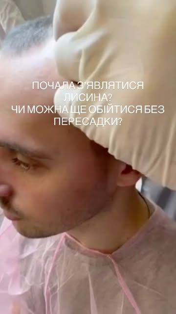 ✅Чи можно ще обійтися без пересадки?
⭐️Так, все починається не з процедур, а з консультації лікаря т
