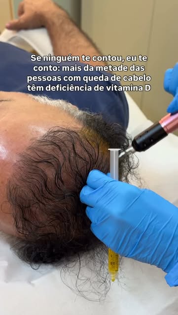 Você sabia que a vitamina D pode ter relação com a saúde dos seus fios? 

A deficiência de vitamina 