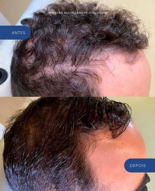 A calvície não afeta só o cabelo. Muitas vezes, ela mexe com a autoestima também. Mas cada caso é ún