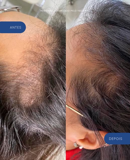 Entradas e cabelo mais ralo também podem impactar — e muito — a autoestima feminina.
Esse resultado 